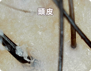 頭皮